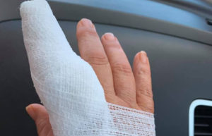 Jerilyn's bone spurs are gone