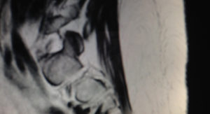 my spine before