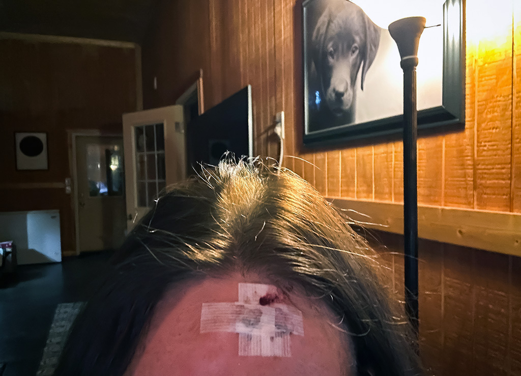 my forehead after surgery